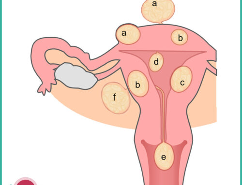 Fibromi uterini: sintomi, diagnosi, terapia