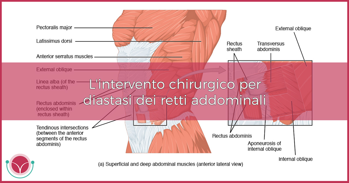 L Intervento Chirurgico Per Diastasi Dei Retti Addominali Luigi Fasolino